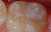 Sealant-After - Pediatric Dentist in Janesville, WI